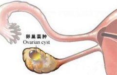 输卵管积水会造成不孕吗？