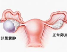 卵巢囊肿，可以做试管婴儿吗？