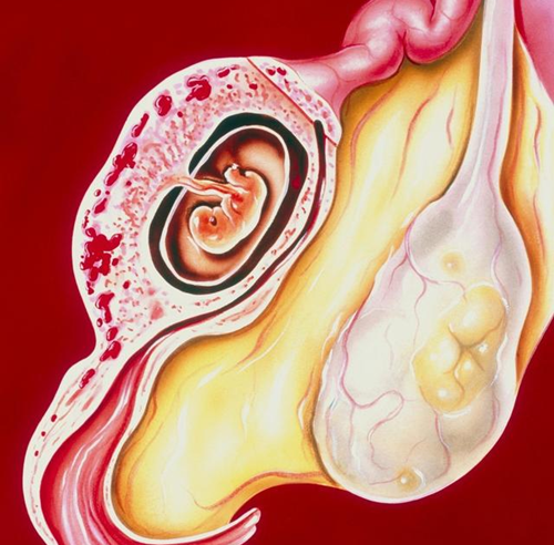 宫外孕,人流,慢性盆腔炎,孕卵游走,输卵管炎症