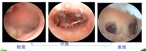 宫腔粘连,盆腔B超,子宫创面修复