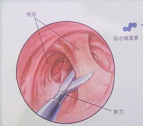 生化妊娠,试管婴儿,不孕不育,精卵品质