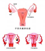 当试管婴儿遇上了输卵管积水应该怎么办呢？