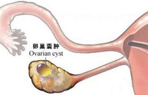 卵巢囊肿,试管婴儿,不孕不育,生育能力