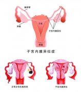 没有输卵管，试管婴儿怎么做的