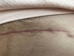 剖宫产3次后还能继续试管怀孕吗？