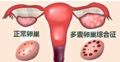 多囊要做哪些检查？能直接做试管吗？