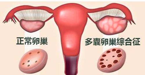 多囊卵巢,分泌代谢异常,不孕不育