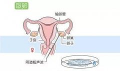 取卵越多 试管婴儿成功率越高吗