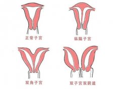 子宫畸形能做试管婴儿胚胎移植吗