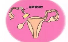 输卵管两侧都切除还能做试管婴儿吗