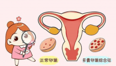 多囊卵巢综合症患者如何调理能快速怀孕