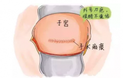 瘢痕子宫可以做试管婴儿吗