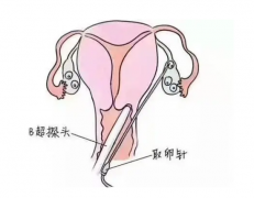 做试管婴儿取卵时疼痛吗？
