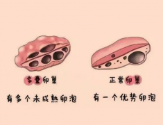 试管婴儿多囊卵巢